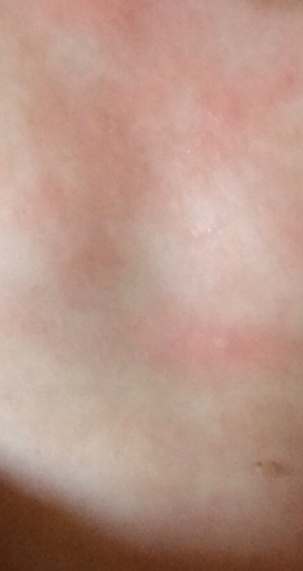 Red Rash The Medical Student Press Blog